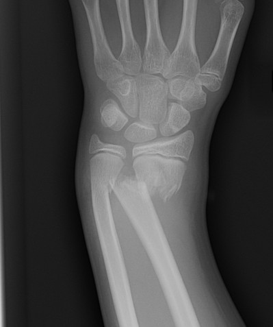 Distal Radius Fracture